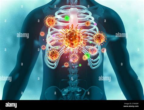 Human Lungs Infected By Virus And Bacteria 3d Illustration Stock Photo