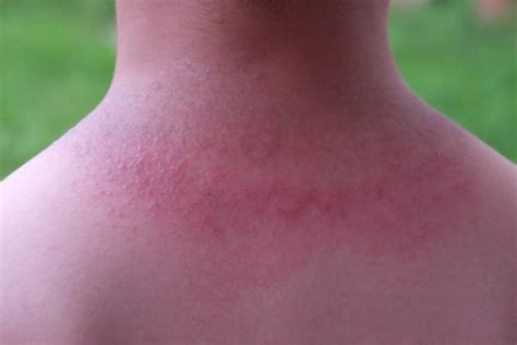 Heat Rash Overview Symptoms Types Causes Diagnosis Home Remedies