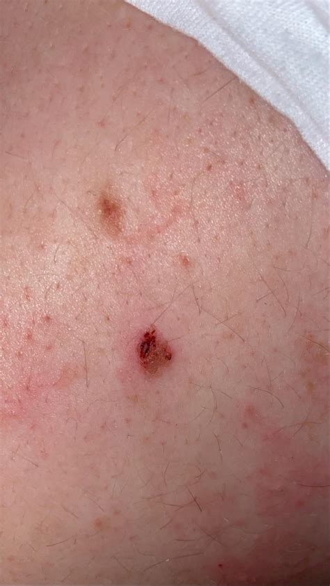 So This Mole Is On My Husband Seems To Scab Up Often Im Making Him