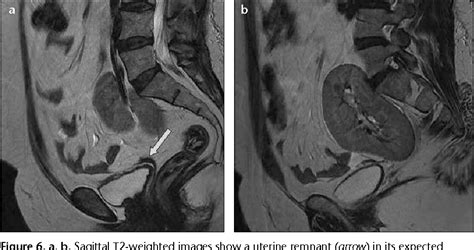 Figure 4 From Mri In The Diagnosis Of Mayer Rokitansky Kuster Hauser