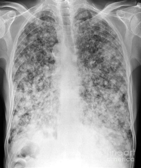 In many cases atelectasis is the first sign of a lung cancer. Secondary Lung Cancers, X-ray Photograph by Du Cane ...