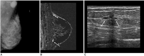 A 42 Year Old Woman With Palpable Left Axillary Lymph Node Metastasis