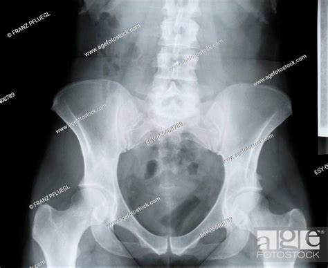 X Ray Skeleton Hip Stock Photo Picture And Low Budget Royalty Free