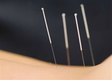 Rls Is Controlled With Acupuncture And Produces Less Adverse Effects