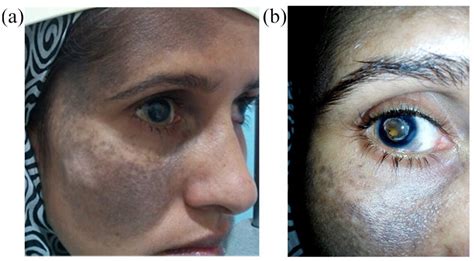 Ophthalmic Associations Of Oculodermal Melanocytosis In A Tertiary Eye