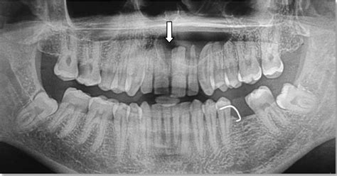 Full Text Management Of An Impacted Inverted Mesiodens Associated