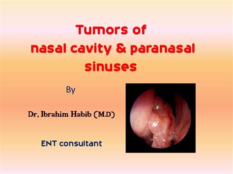 Early Stage Nasal Cavity Cancer 1 Over 90 Derive From Squamous
