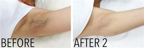 Laser Hair Removal Using Mulitple Laser Platforms Results Driven