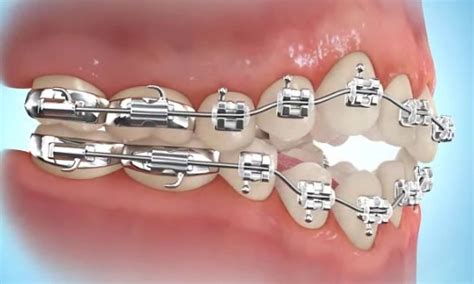 How to put rubber bands on braces for underbite. How to Put Rubber Bands On Braces | Premier Orthodontics