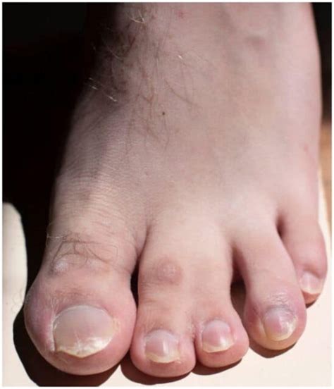 Syndactyly Webbed Toes Spiritual Meaning And Causes Insight State