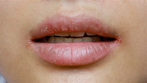 Psoriasis On Lips Photos