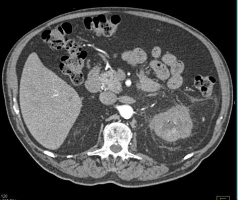 Acute Pyelonephritis Kidney Case Studies Ctisus Ct Scanning