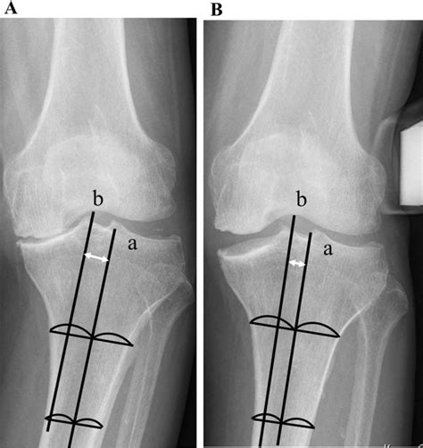 A Measurement Of The Tibiofemoral Subluxation The Tibial Anatomical