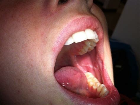 Kondisi Ini Normal Terjadi Di Rongga Mulut Jangan Panik