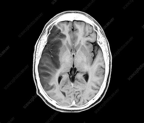 Stroke Mri Brain Scan Stock Image C0371583 Science Photo Library