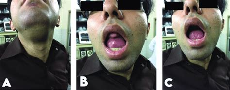 A Extra Oral Frontal View Of The Giant Dermoid Cyst B Intra Oral