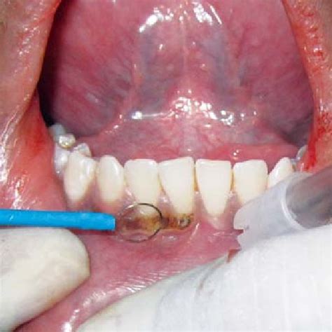 Localized Blood Filled Bulla Found On The Gingiva Associated With Mmp