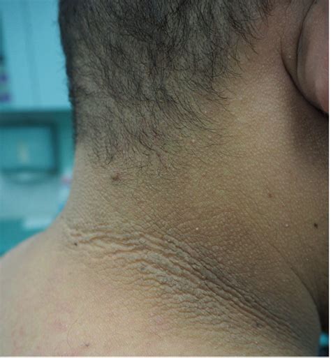 Acd A Z Of Skin Acanthosis Nigricans