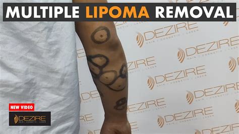 Multiple Lipoma Removal Surgery Lipoma Treatment Done By Dr Prashant