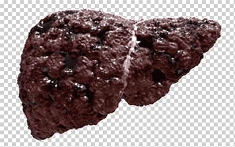 Цирроз печени Хроническая болезнь печени Алкогольная жировая болезнь Картинка - Цирроз печени Хроническая болезнь печени Алкогольная жировая болезнь