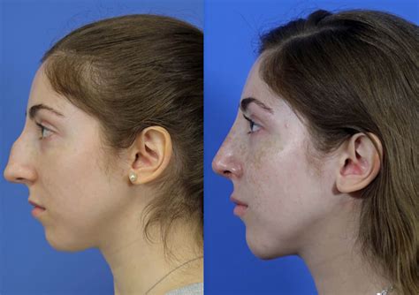 Rhinoplasty Nose Job Before And After Photos Savannah Facial Plastic Surgery