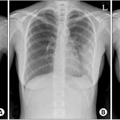 Chest X Ray Finding A There Is No Significant Abnormality On The Day