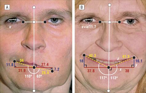 Assessing Outcomes In Facial Reanimation Evaluation And Validation Of The Smile System For