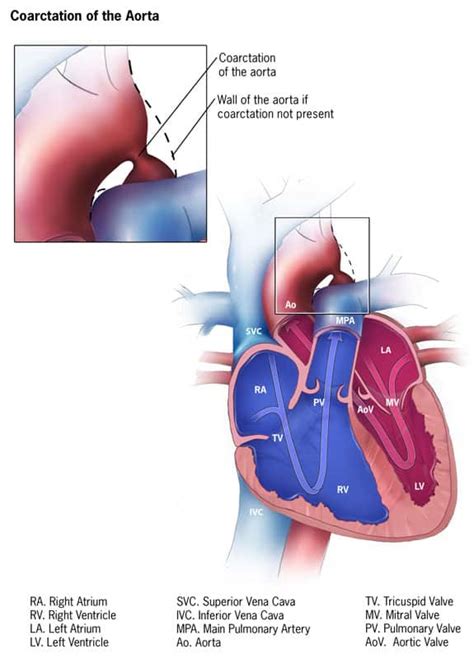Coarctation Of The Aorta Almostadoctor