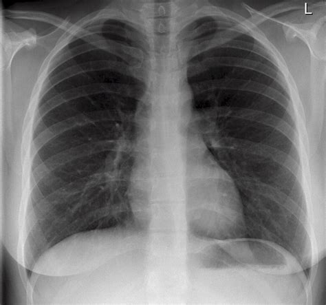 Normal Chest X Ray A Photo On Flickriver