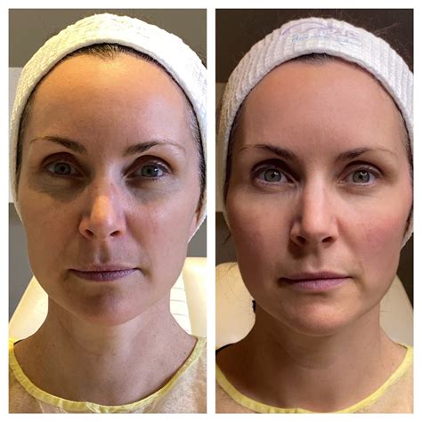 Thread Lift The Non Invasive Face Lift Skins Derma Care