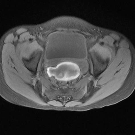 Occasionally they may produce bloating, lower abdominal pain, or lower back pain. A case of unilateral ovarian torsion: Tale with a twist ...