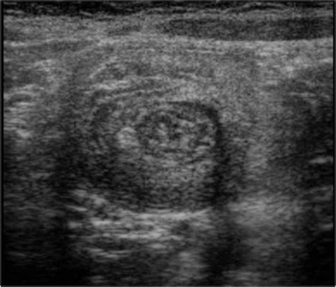 Ultrasound Features Of Intussusceptions Us Obtained Near The Apex