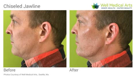 Being born with a strong commanding jawline depends upon several individual genetic factors. Chiseled-Jawline-Seattle-Well-Medical-Arts-Before-After_AW ...