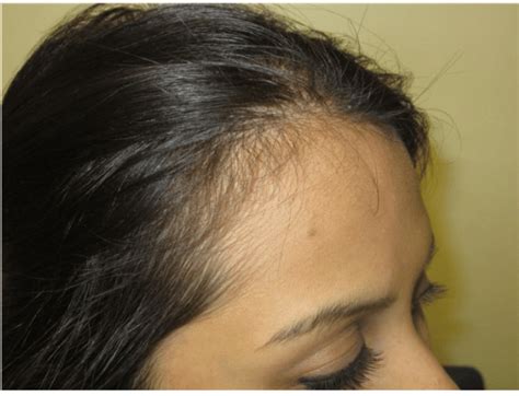 Non Scarring And Scarring Alopecia Beauty Beyond The Crown®