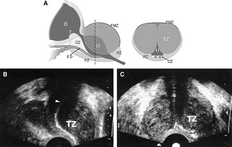 Ultrasound Type 1 Bph Bilateral Tz A Diagrammatic Sagittal Left