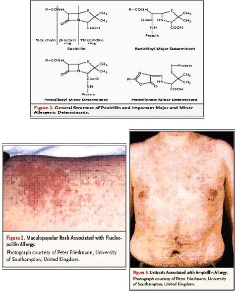 Usah Kau Lara Sendiri Alergi Antibiotik