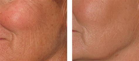 Genius Southern Cosmetic Laser Charleston Botox Massage And Skin