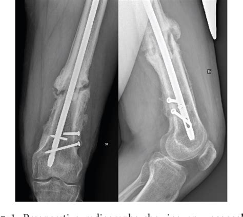 Figure 1 From Treatment Of A Femur Nonunion With Microsurgical