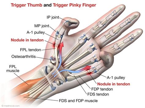 Trigger Finger Tendon Nodule