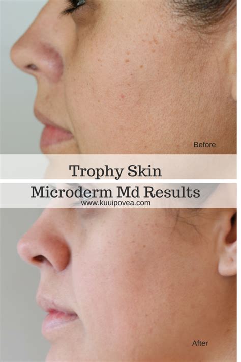 MicrodermMD Before And After Ku Uipo Vea Microderm