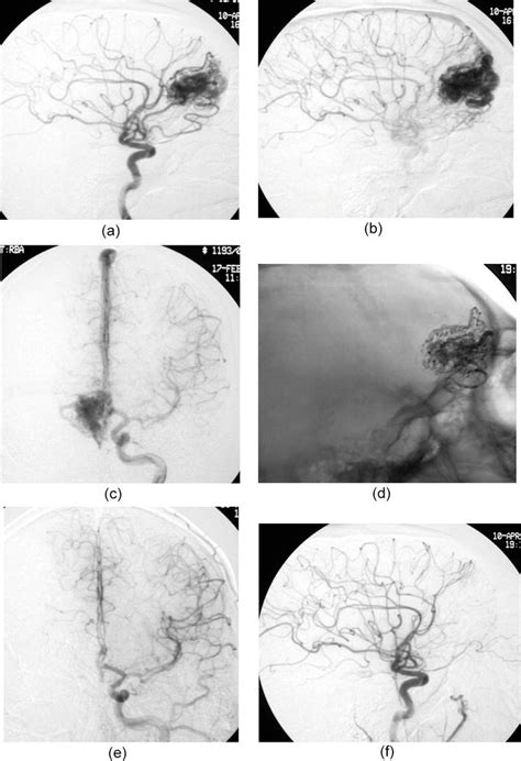 Endovascular Treatment Of Cerebral Arteriovenous Malformations