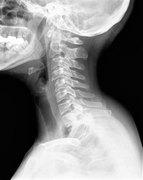 Surgery On Multilevel Cervical Spinal Stenosis And Spinal Injury
