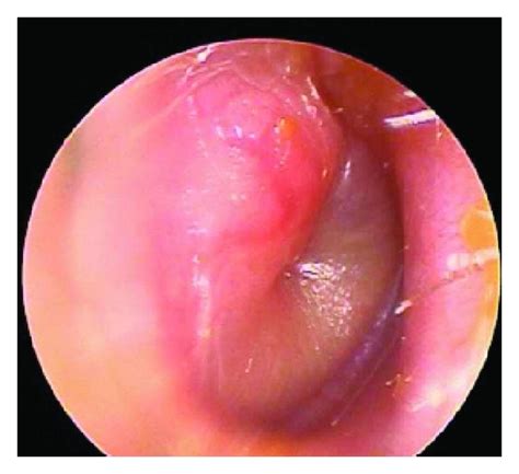 Automated Diagnosis Of Otitis Media Vocabulary And Grammar