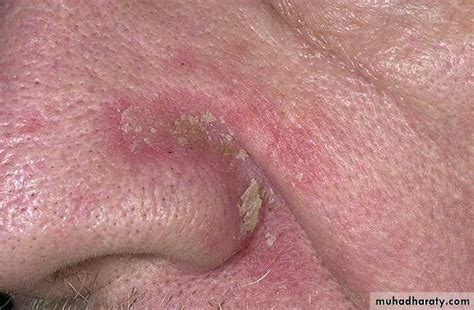 Endogenous Eczema Pptx دمنار Muhadharaty