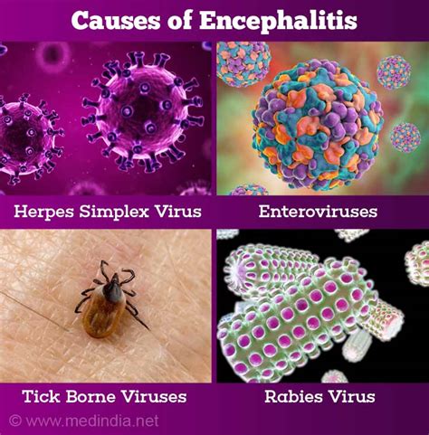 Encephalitis - Causes, Symptoms, Diagnosis, Treatment & Prevention