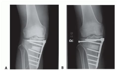 Upper Tibial Osteotomy High Tibial Osteotomy Musculoskeletal Key