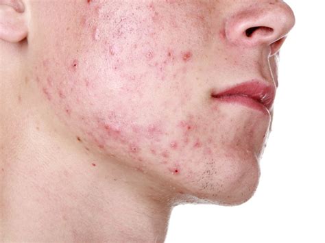 Say Goodbye To Acne Rosacea Proven Techniques For Relief