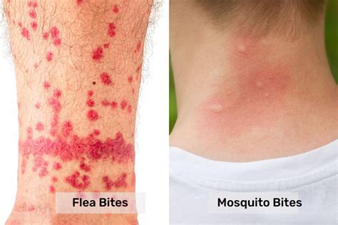 Flea Bites Vs Mosquito Bites Pest Control Gurus