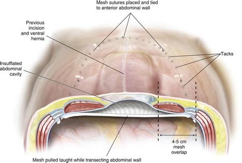 Laparoscopic Ventral Hernia Repair—standard Clinical Gate