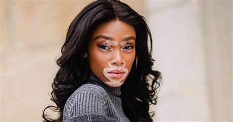 Model Winnie Harlow Isnt A ‘vitiligo Sufferer